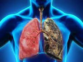 THẮC MẮC: Triệu chứng ung thư phổi giai đoạn đầu là gì?